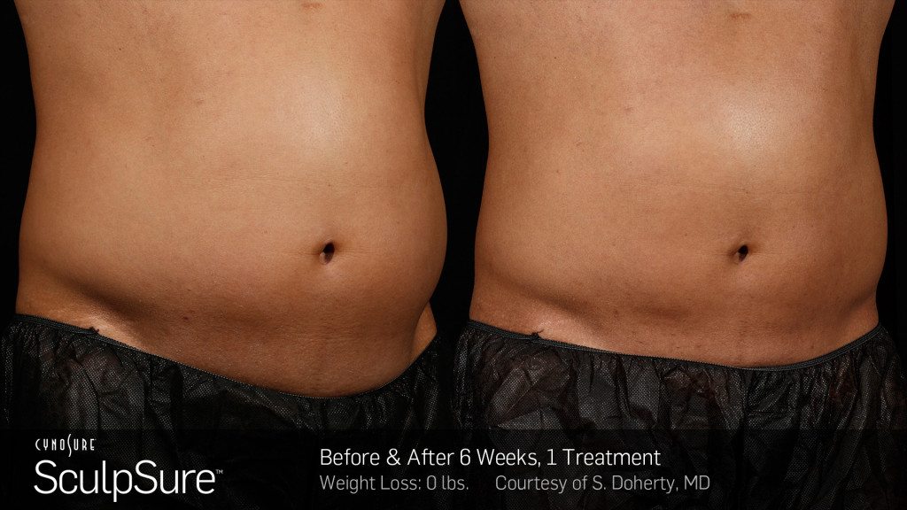 BA-SculpSure-S-Doherty-Post1Tx-6weeks-05