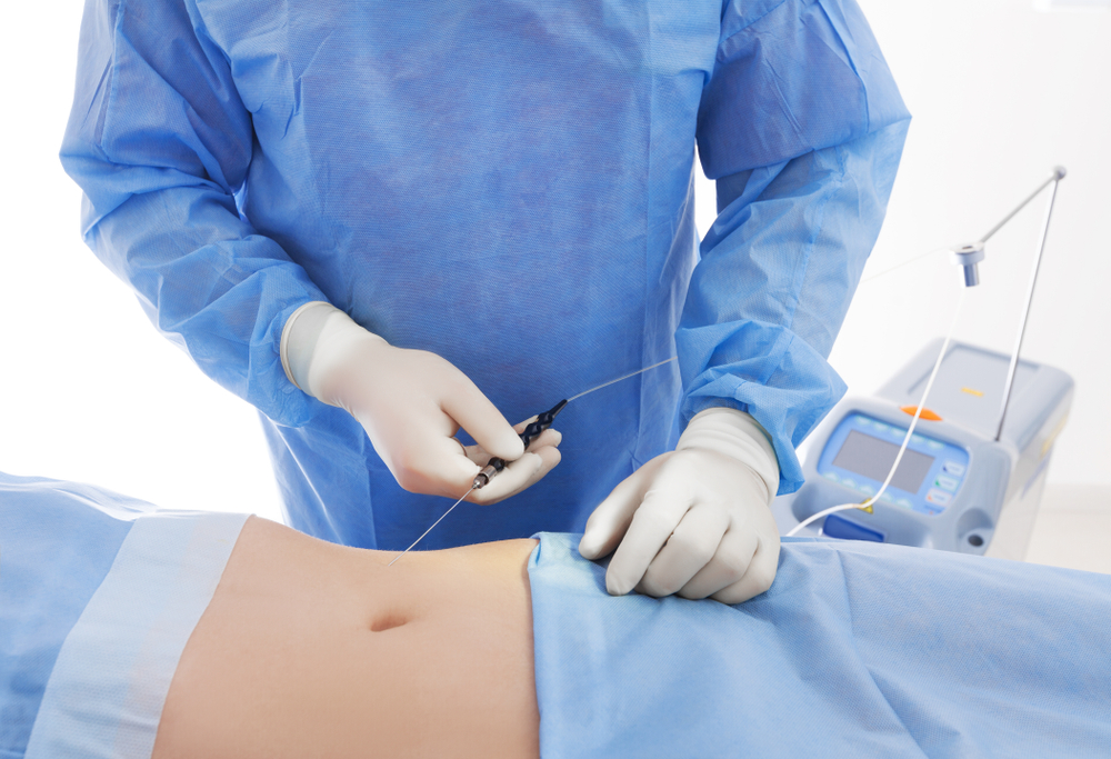 Laser Lipo 101: The Minimally Invasive Liposuction Technique ...